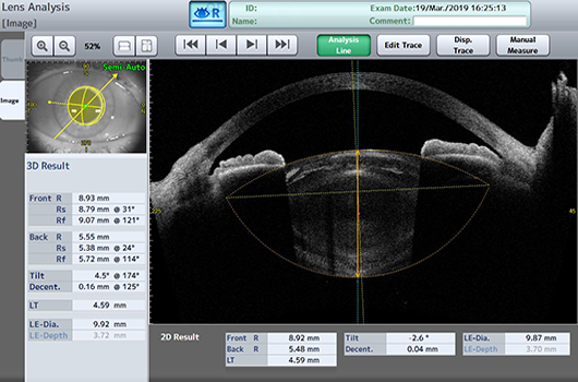 Cataract Lens Analysis