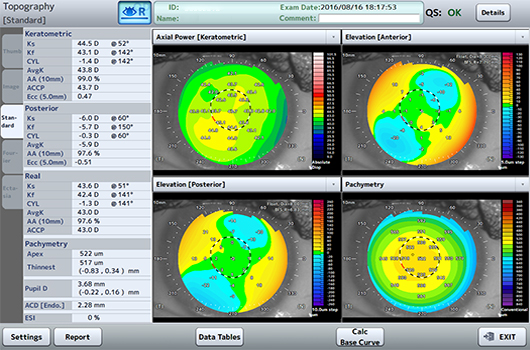 Cornea Topography