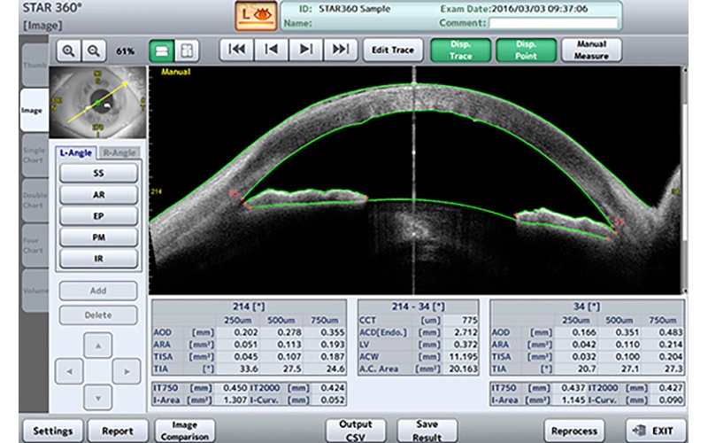 Glaucoma detail 1