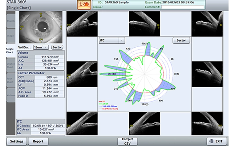 Glaucoma detail 2