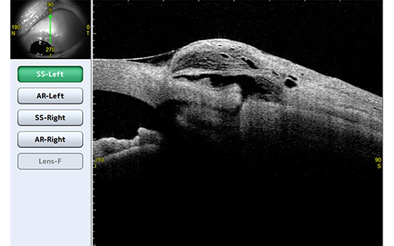 Glaucoma detail 3